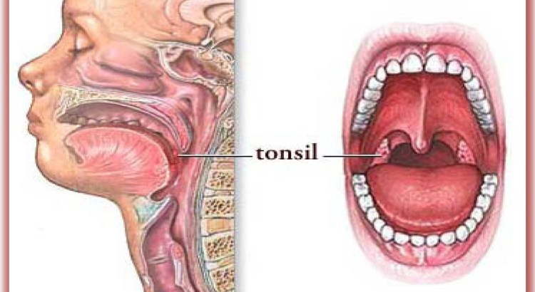 "Тонзиллит" - tonsil 1